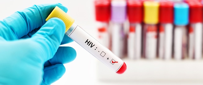 اكتشاف نوع جديد من فيروس الإيدز أشدّ ضراوة