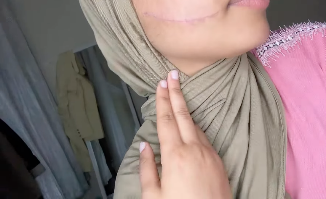 التلميذة “سلمى” تستعرض نتائج جراحة تجميلية بمراكش