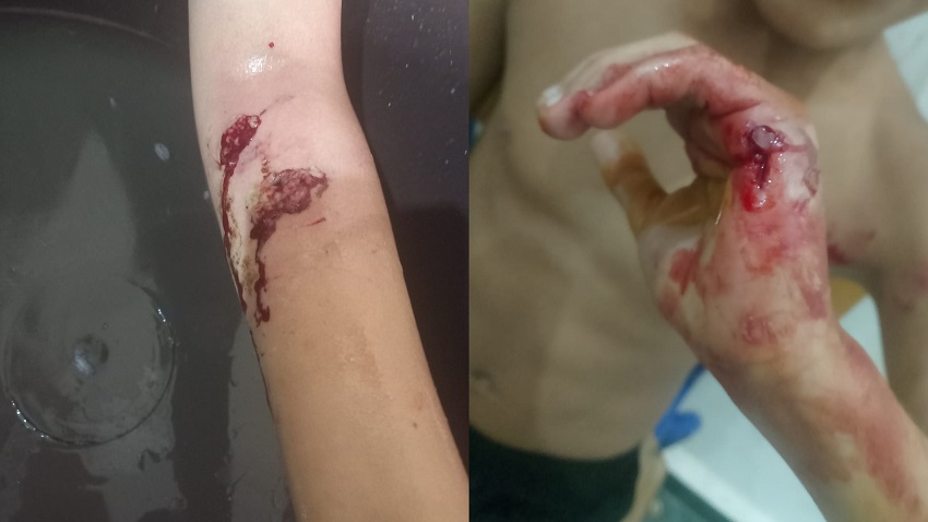 وفاة طفل بالعروي ضواحي الناظور بعد ثلاثة أسابيع من عضة كلب ضال