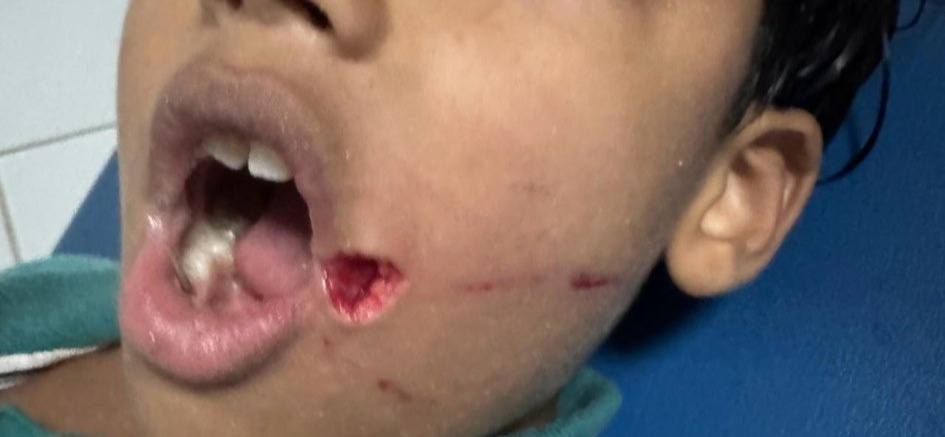 كلبان يهاجمان طفلا بشراسة على مستوى الوجه والبطن بشاطئ الصويرة +صور