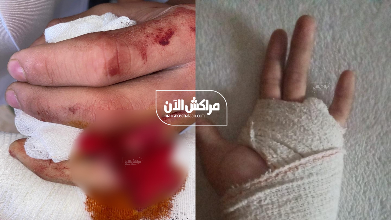 حصري.. أمن مراكش يدخل على خط قضية “بتر أصبع تلميذ” بمؤسسة خاصة